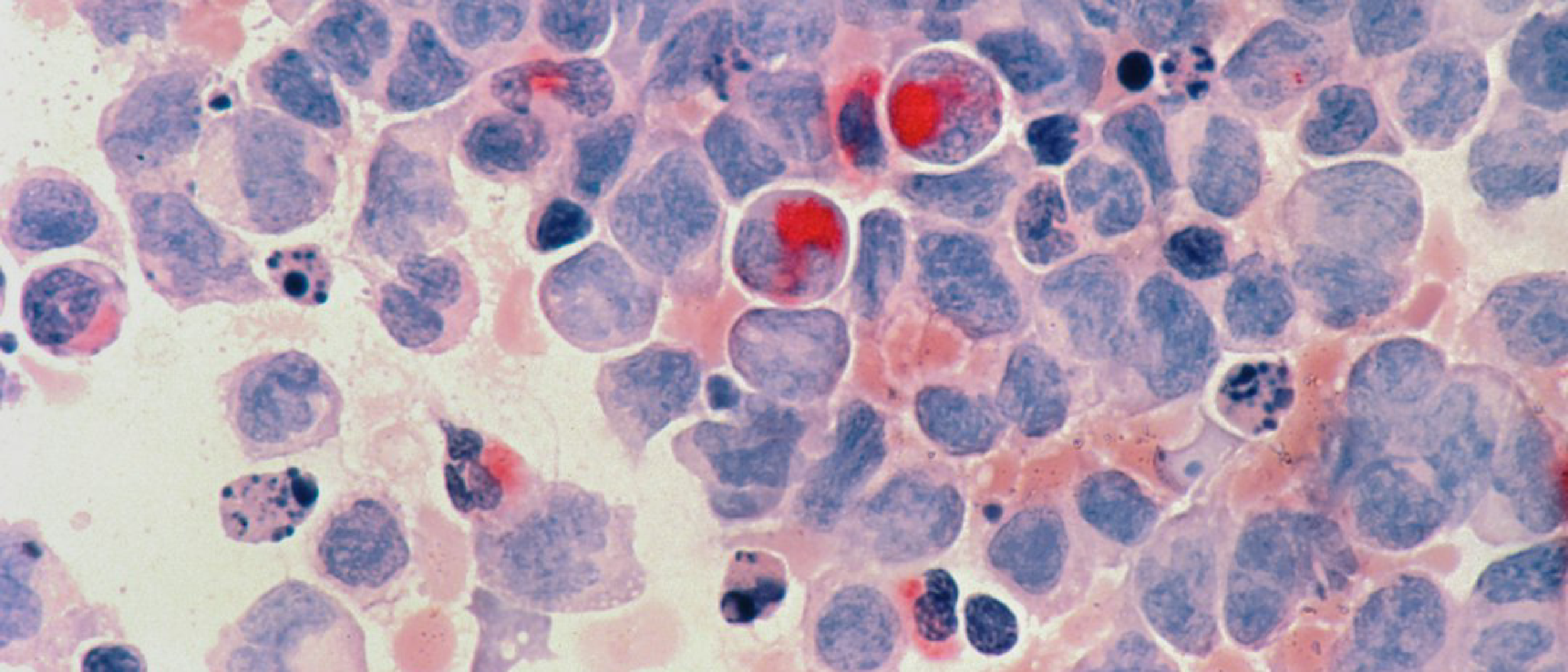 ALDH3B2 Silencing Turns Duct Cells Into Insulin Makers