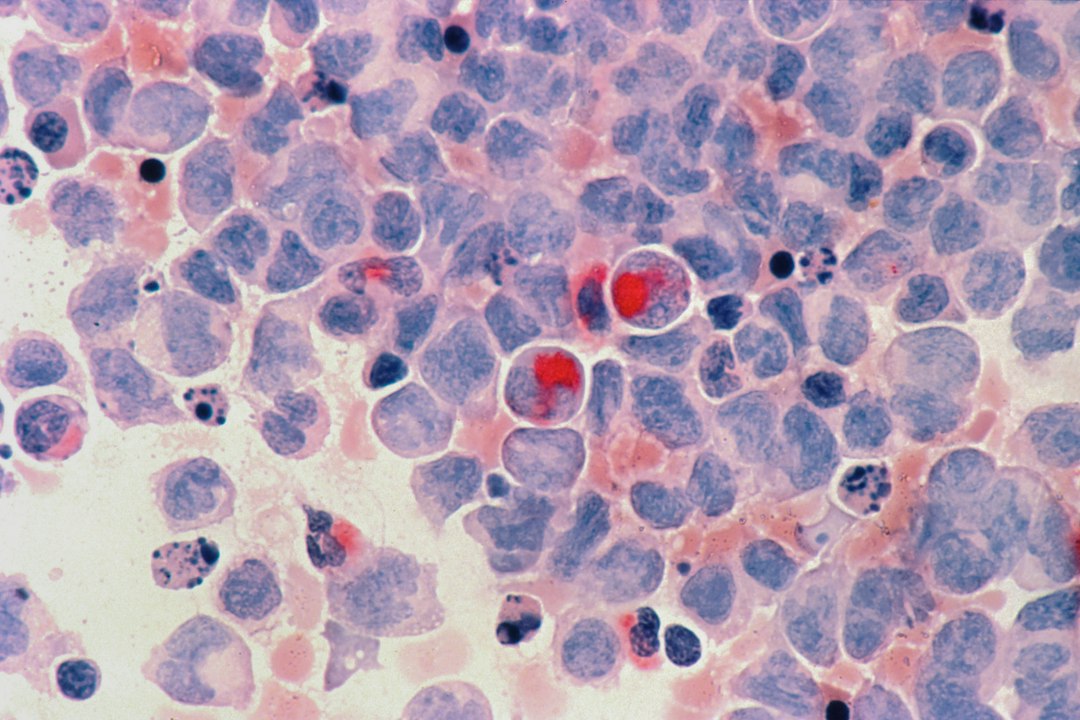 ALDH3B2 Silencing Turns Duct Cells Into Insulin Makers
